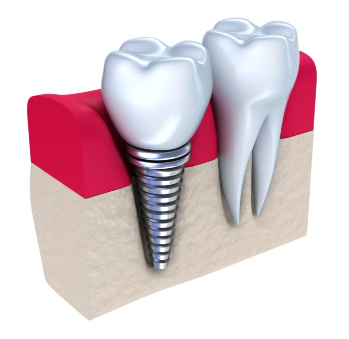 Dental implant services in Monroe NC