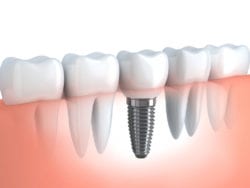 Dental implants with dentist in Monroe North Carolina