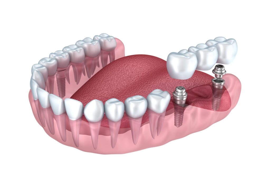 multiple dental implants in monroe, nc