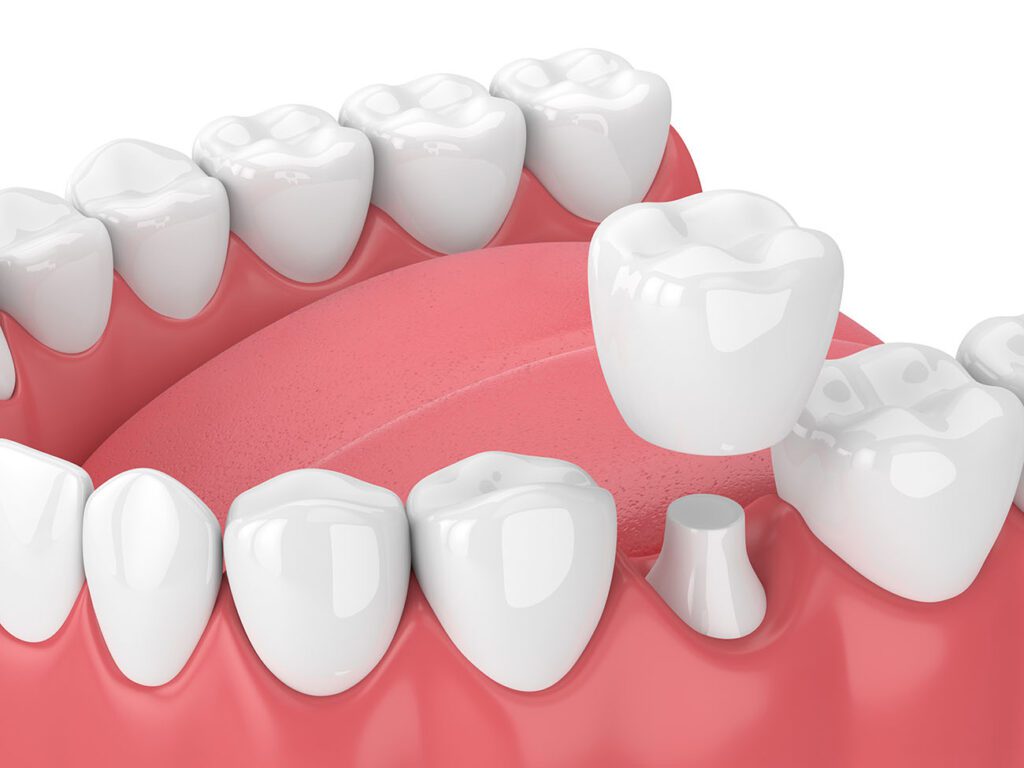 DENTAL CROWNS in MONROE are a procedure to help preserve and protect your teeth or implants