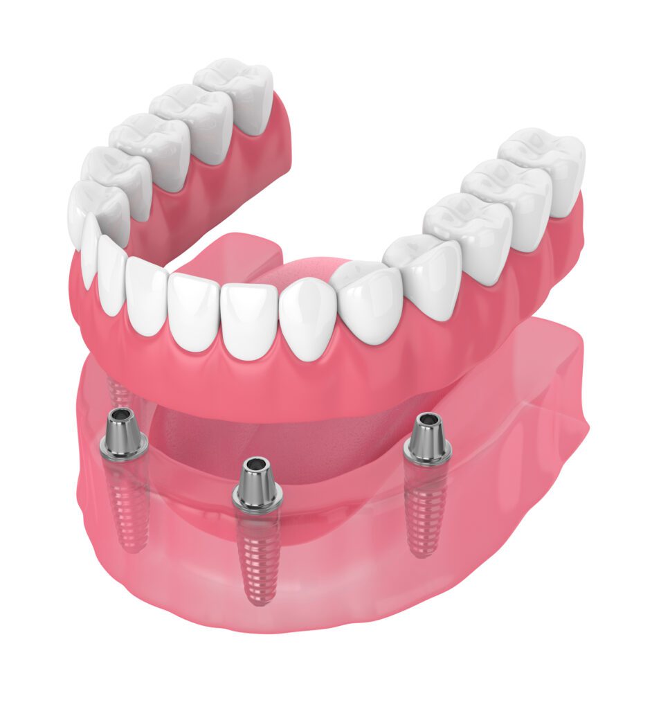 Dental Implants in Monroe NC could help restore your bite after tooth loss