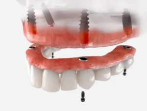 Are Dental Implants Worth the Cost? in Monroe, NC
